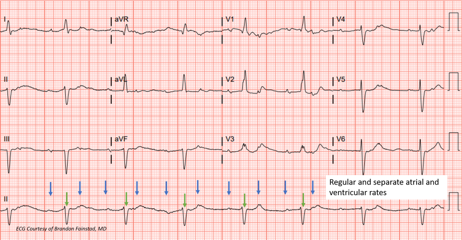 Atrioventricular (AV) Heart Blocks Archives teachIM