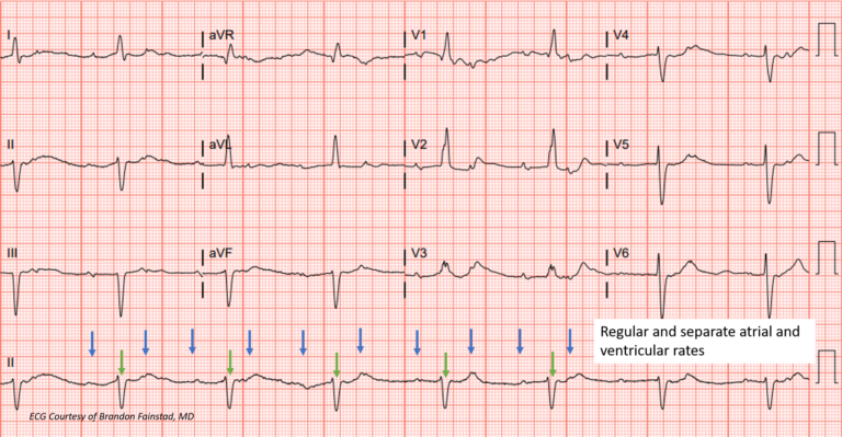 Atrioventricular (AV) Heart Blocks Archives - teachIM