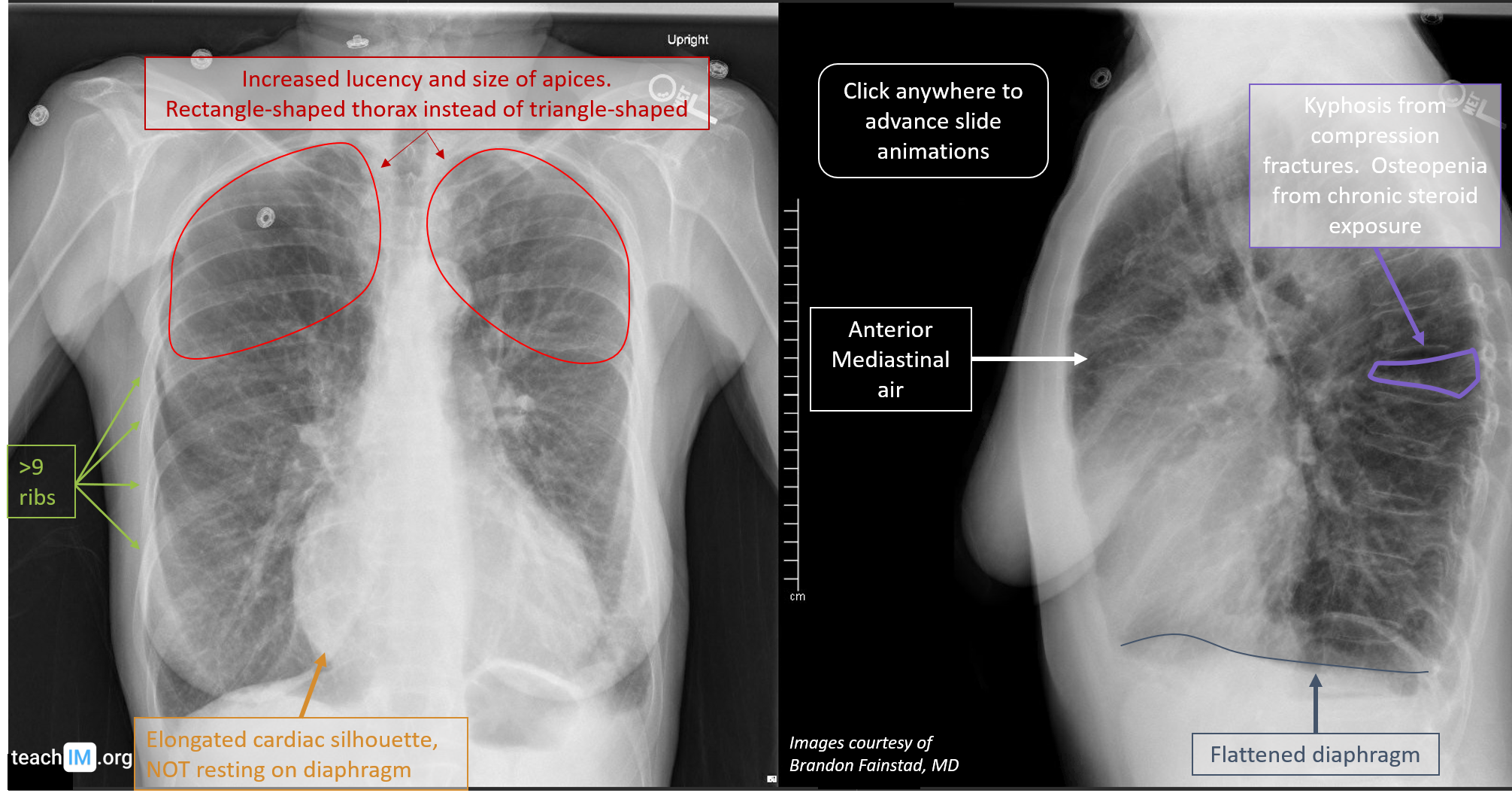 Emphysema Chest X Ray