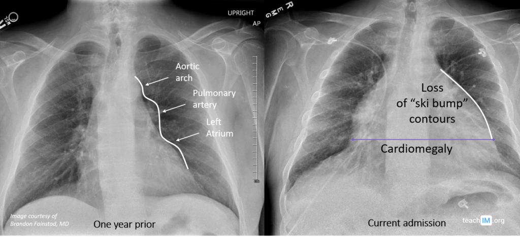 Chest X ray Archives TeachIM