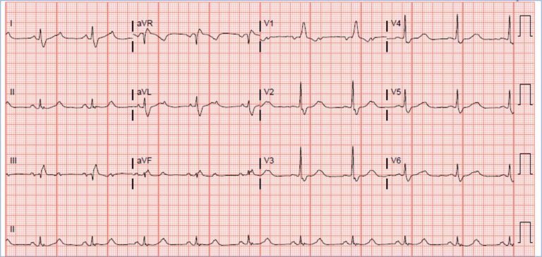 ECGs Archives - teachIM