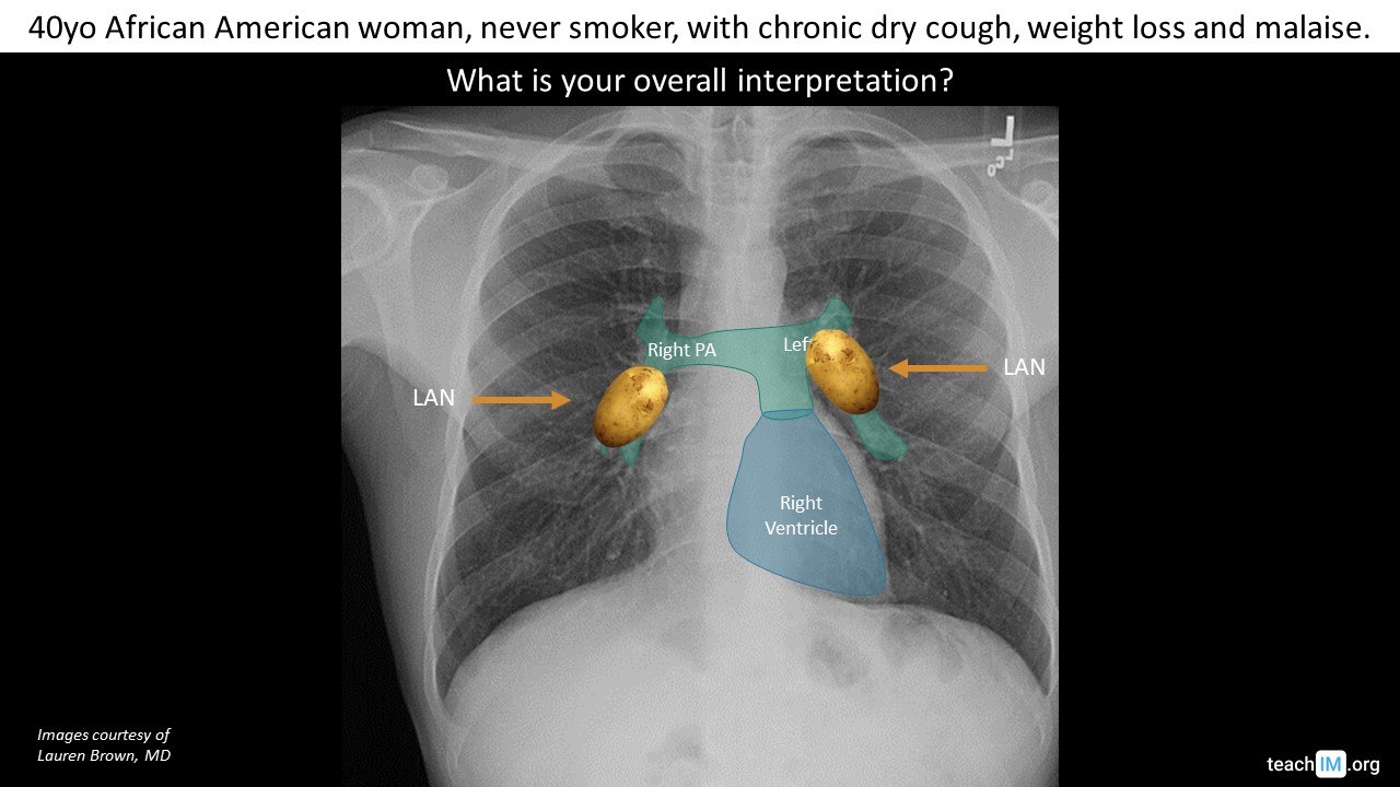 Hilar Lymphadenopathy Sarcoidois Cxr Teachim