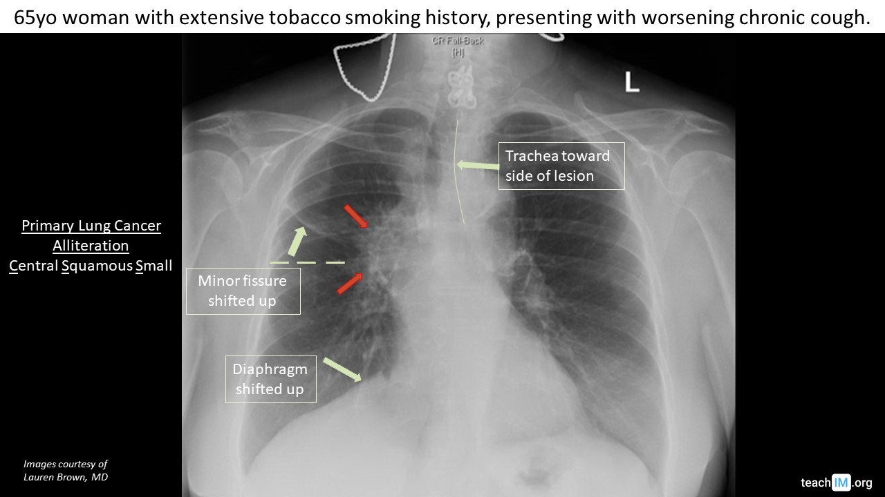 Hilar Mass - Primary Lung Cancer - teachIM