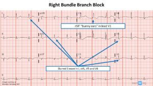 Bundle Branch Block Archives - teachIM