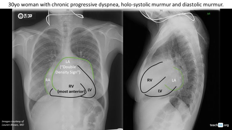 Chest x-ray Archives - teachIM