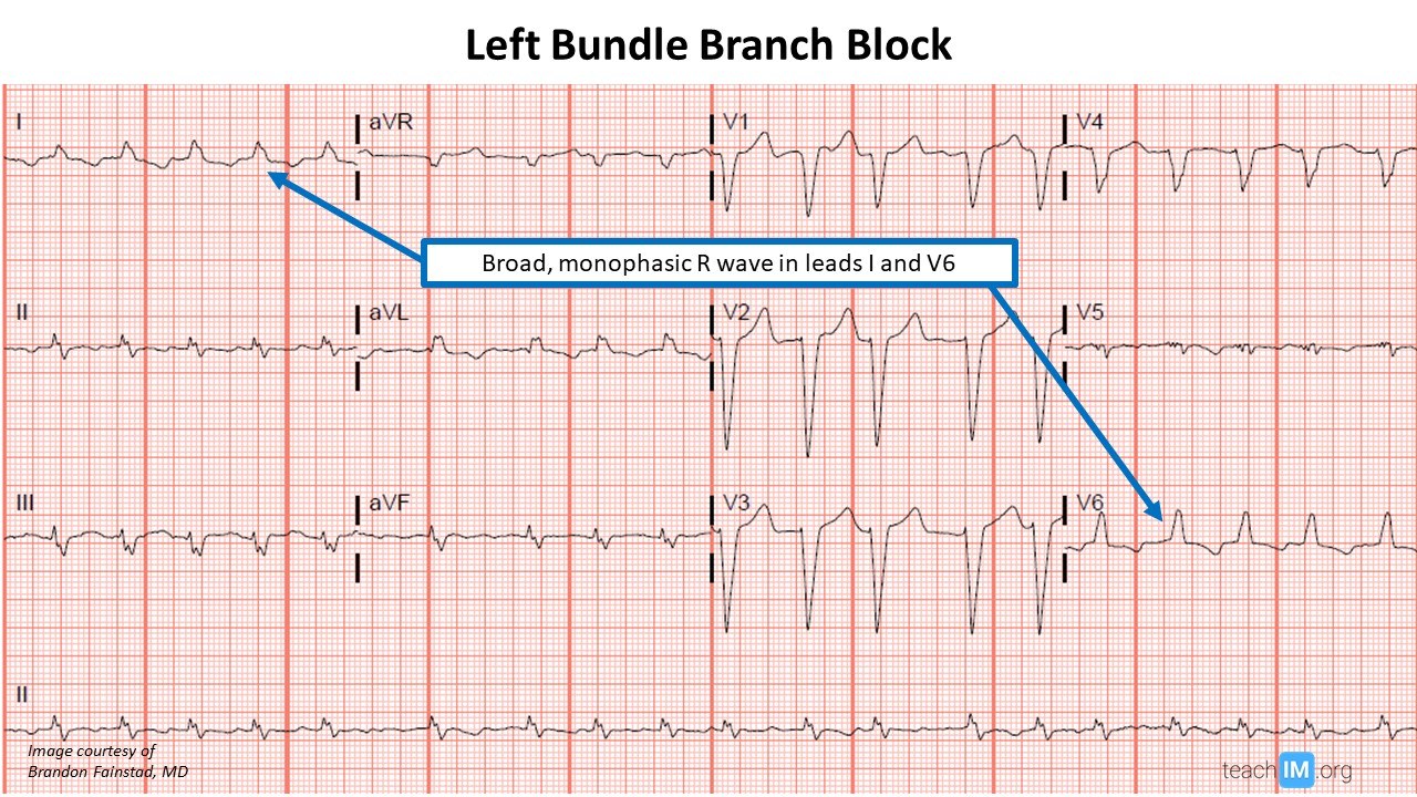 Medial Bundle Branch Block