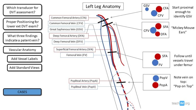 Deep Vein Thrombosis DVT POCUS TeachIM