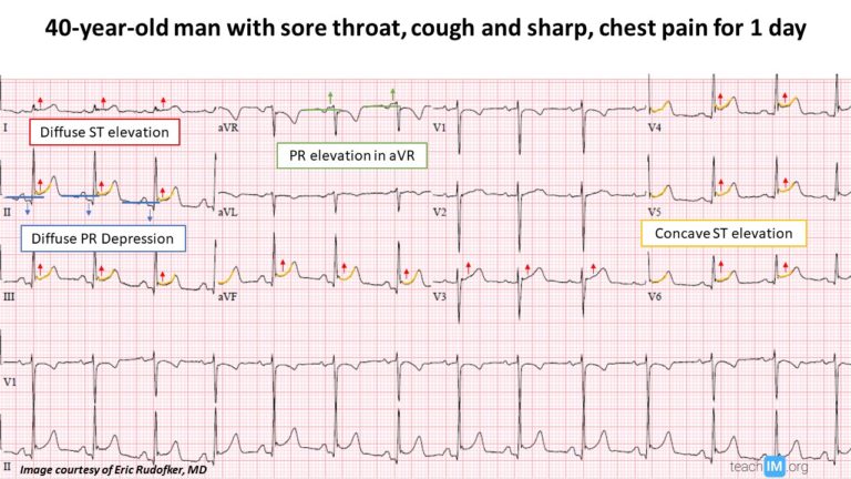 ECGs Archives - teachIM