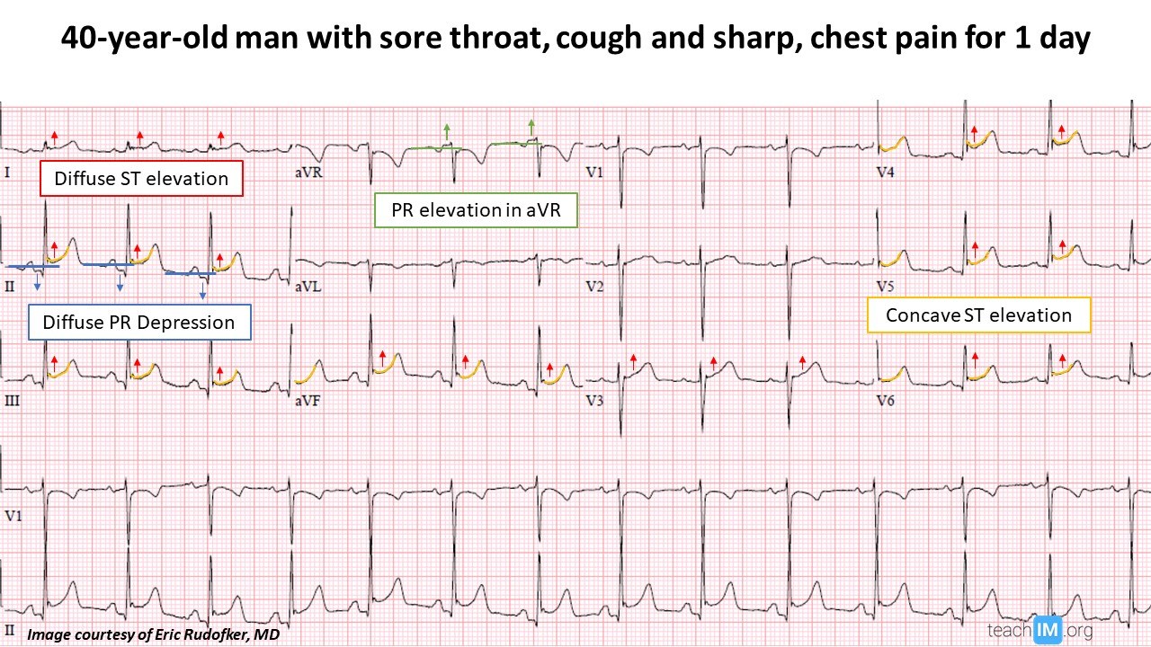 Pericarditis | ECG | teachIM