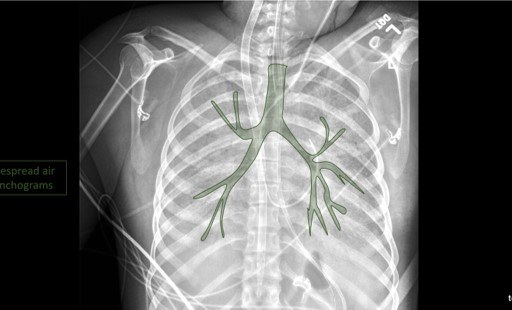 Chest X ray Archives TeachIM