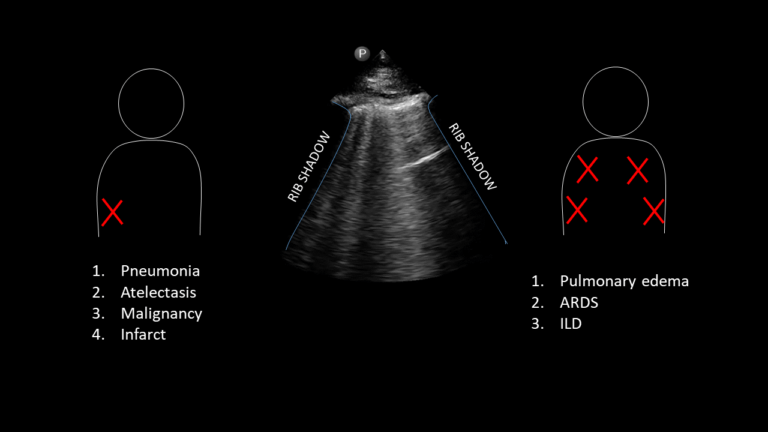 CHF Exacerbation (B-lines) Lung Ultrasound | POCUS | TeachIM