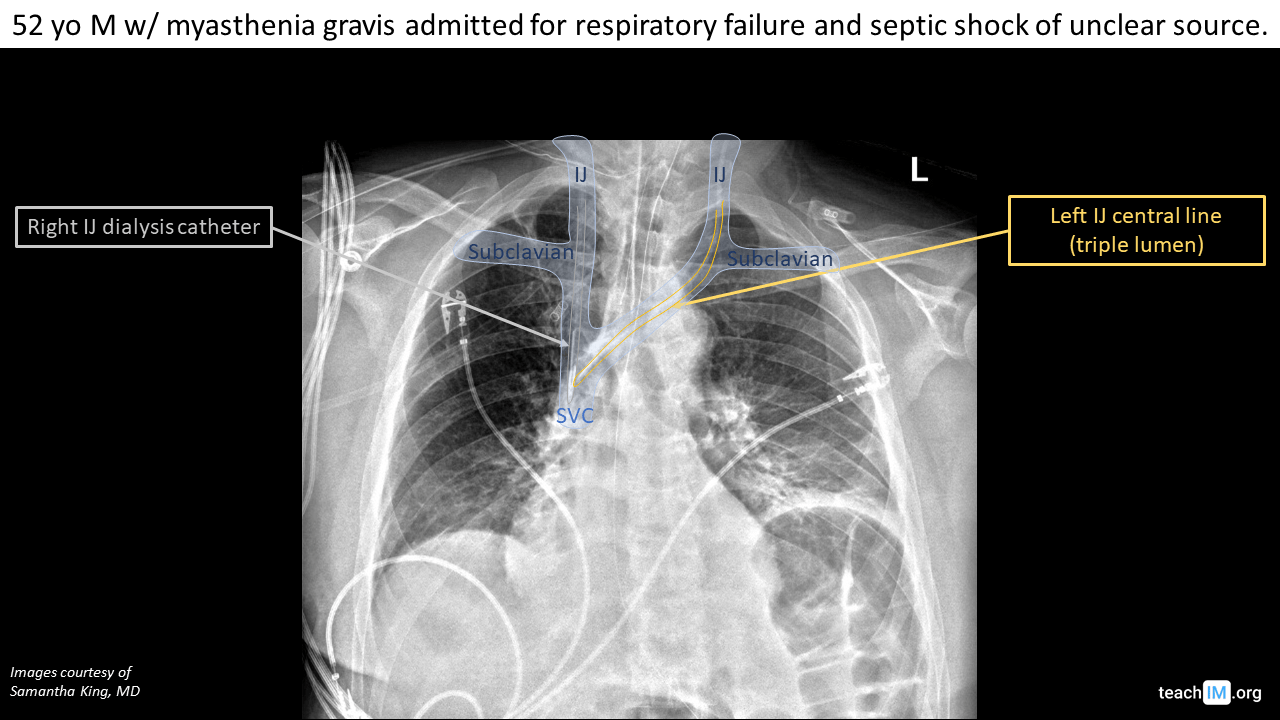 central-line-placement-cxr-teachim