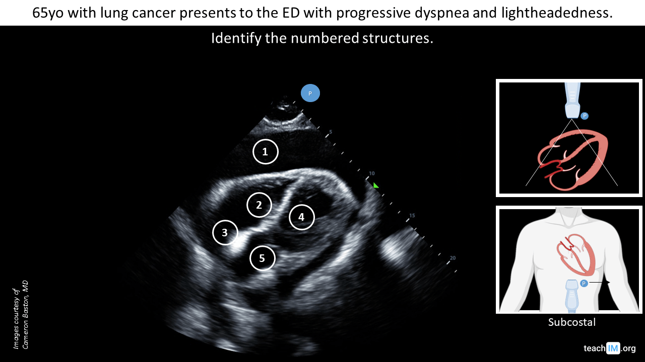 UAB Emergency Ultrasound on X: Wall-Echo-Shadow (WES) sign! No fooling you  #POCUS pros!  / X