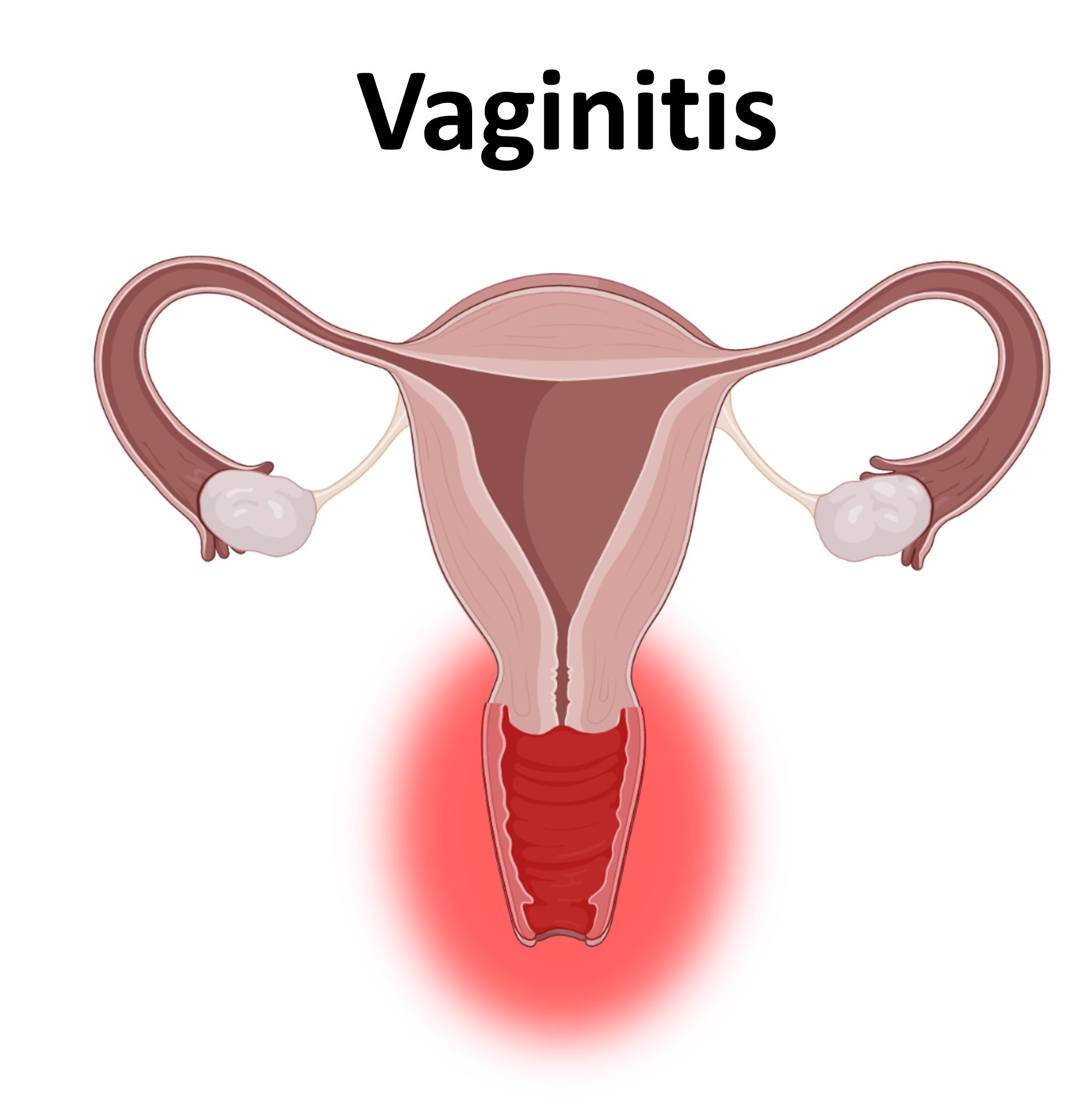 Atrophic vaginitis - Wikipedia