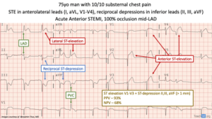 Anterior STEMI ECG